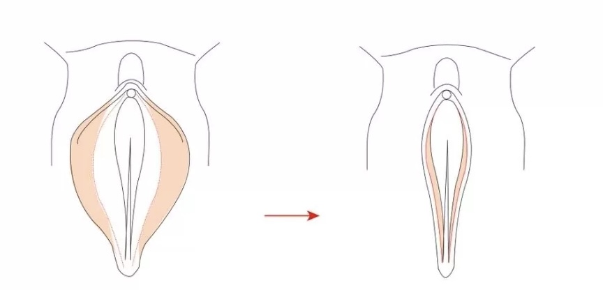 Вагинопластика - результаты до и после